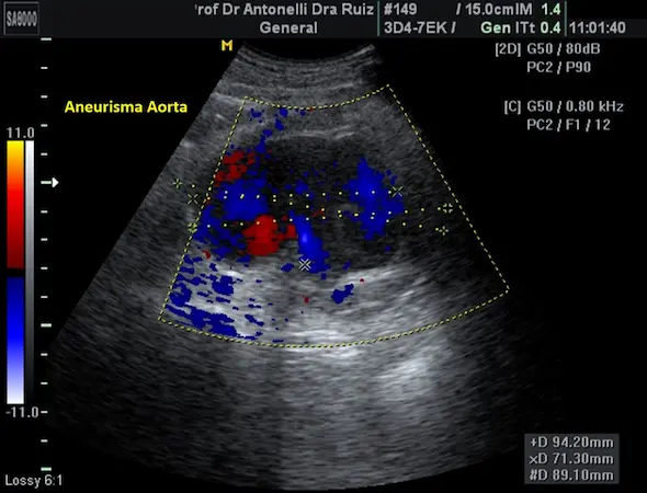 eco doppler aneurisma aorta abdominal