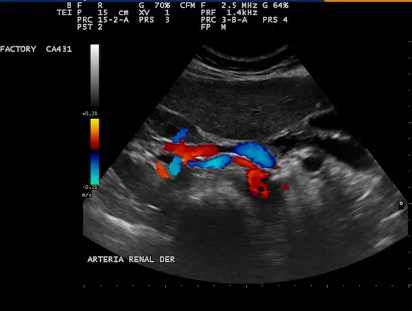 eco doppler arterias renales